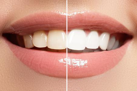 Before and after