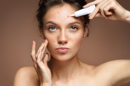 teenage girl with acne applying a skin treatment