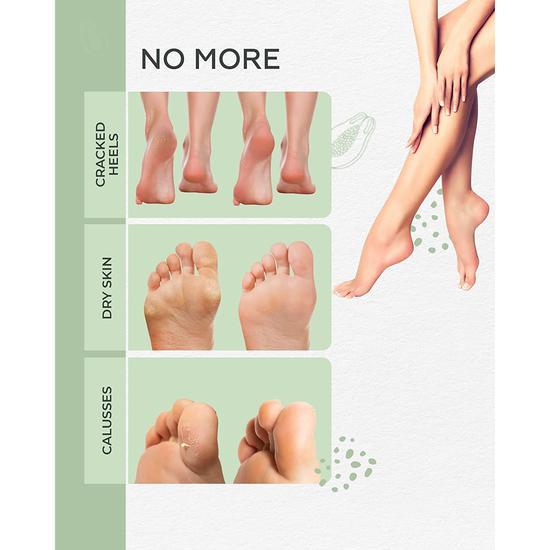 Baby Foot Treatment Exfoliation Foot Peel