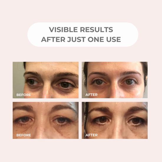 BEAUTICAL Microneedle Eye Patches
