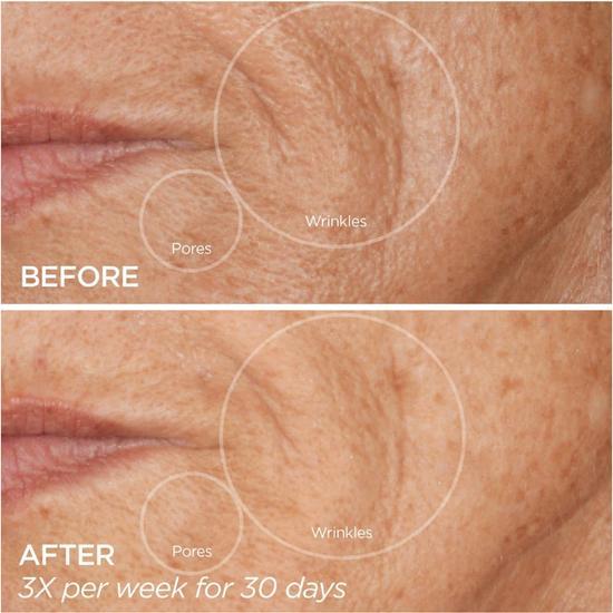 BeautyBio GloPRO FACE MicroTip Microneedling Attachment Head