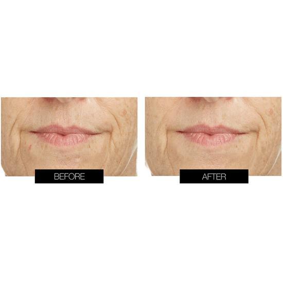 CurrentBody Skin LED Lip Perfector Youthful-looking lips in 3 minutes a day