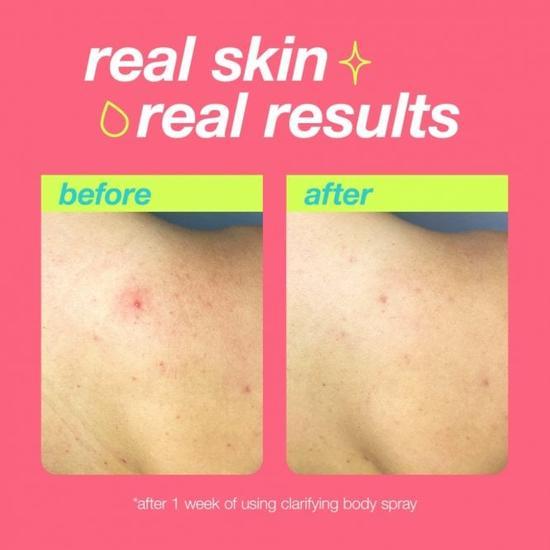 Dermalogica Clear Start Clarifying Breakout Body Spray 177ml
