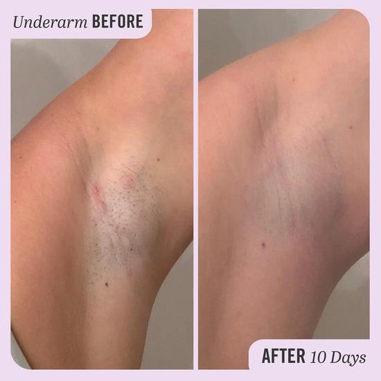 First Aid Beauty Ingrown Hair Pads 28 Pads