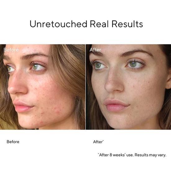 Murad InvisiScar Resurfacing Treatment