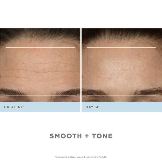 NuFACE Trinity + Wrinkle Reducer