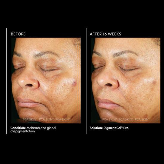PCA SKIN Pigment Gel Pro 29ml