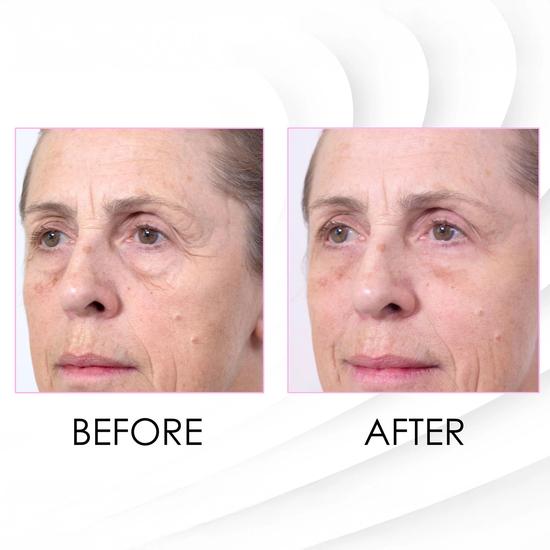 skinChemists Wrinkle Killer Instant Face Lift 5 x 2ml