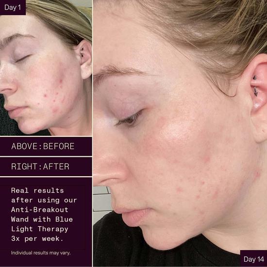 Solawave Anti-Breakout Skin Care Wand With Blue Light Therapy Blue light technology that fights acne & blemished skin