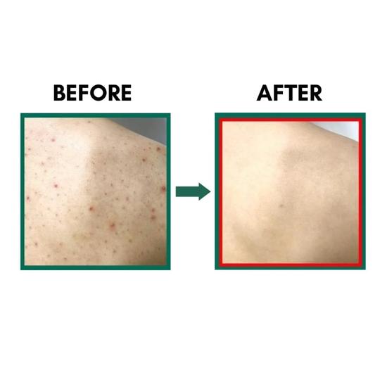 Some by Mi 30 Days AHA BHA PHA Miracle Acne Clear Body Cleanser 400g