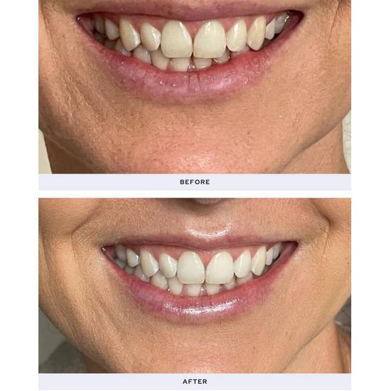 Spotlight Professional LED Teeth Whitening Kit LED Whitening Device + Whitening Pen + Whitening Strips x 10