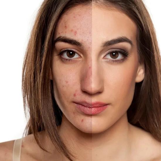 Starest Acne Control Set