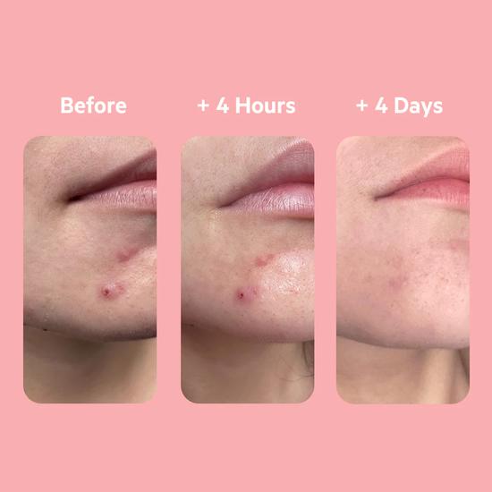 SVR SEBIACLEAR 4hr Gel Flash 15ml