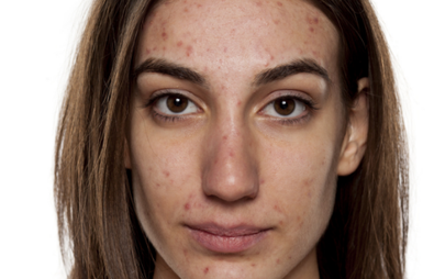 Adult Acne: Why You Get It and How to Tackle it