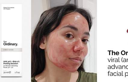The Ordinary Chemical Peel Review cover image