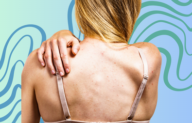 How to Get Rid of Bacne and Other Body Acne