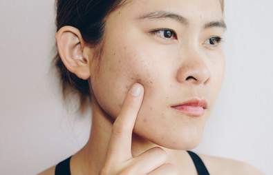 Adult Acne: Why You Get It and How to Tackle it