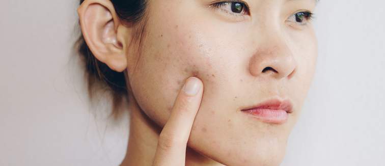 woman with acne