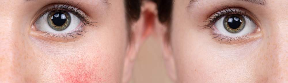 lady with rosacea