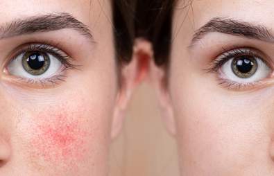 15 Rosacea Skincare Products to Soothe Redness