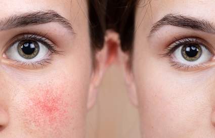 lady with rosacea