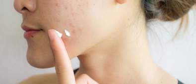 lady with blemishes applying acne scar treatment