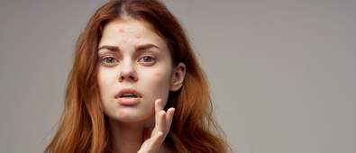 top 6 moisturisers for acne