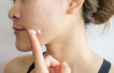 The Best Acne Scar Treatments for Blemish-Free Skin