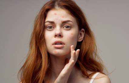 top 6 moisturisers for acne