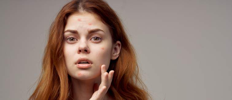 top 6 moisturisers for acne