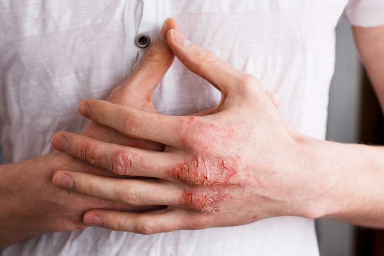 Eczema hands