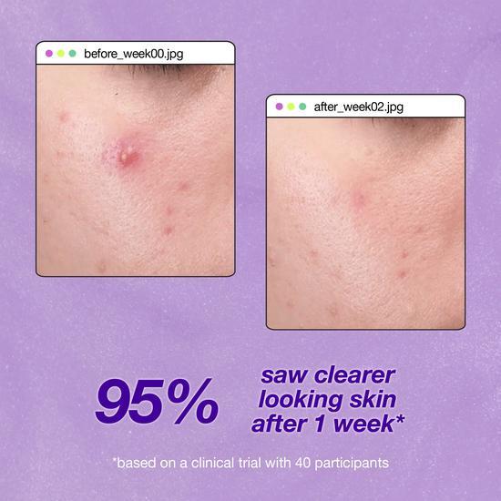 Dermalogica Breakout Clearing Liquid Peel 1 oz