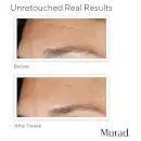 Murad Replenishing Multi Acid Peel