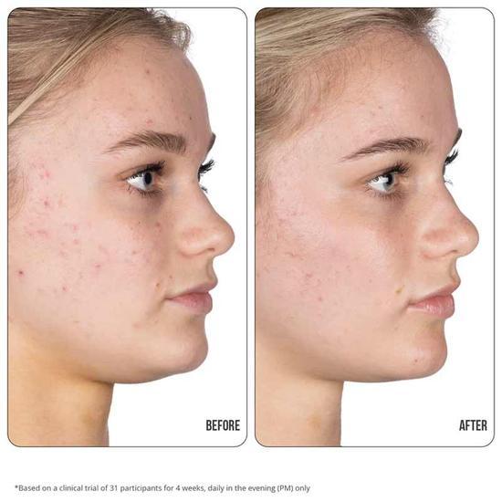 NIP+FAB Retinol Fix Blemish Treatment Gel 10% 0.5 oz
