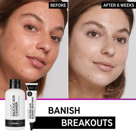 The INKEY List Back To Basics: Your Breakout Recipe Cleanser + Treatment + Moisturiser